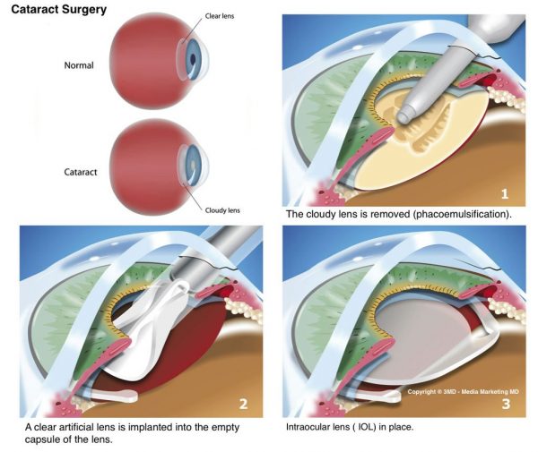 cataract-surgery-3MD