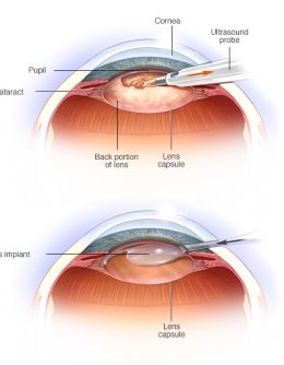 cataract.vs normaljpg