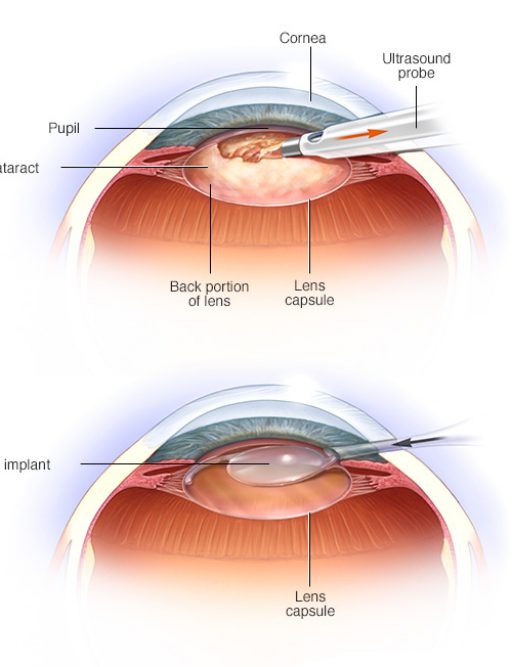 cataract.vs normaljpg