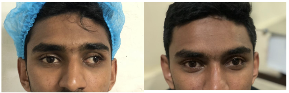Squint correction in eye clinic- Kandy